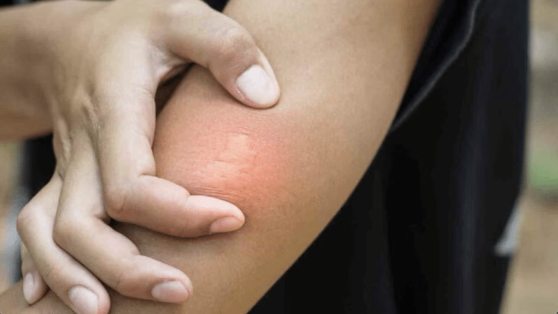 bee stings, like the one on this person's elbow, will turn red and frequently swell