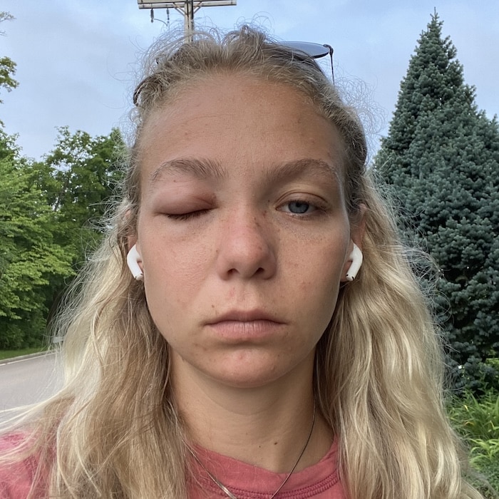 bee sting to the face, eye swollen shut