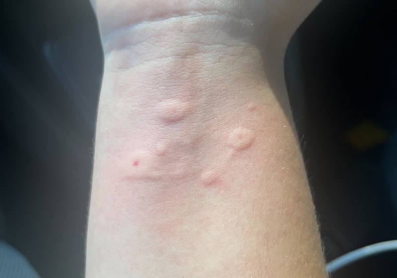 bee stings causing hives on beekeeper's wrist