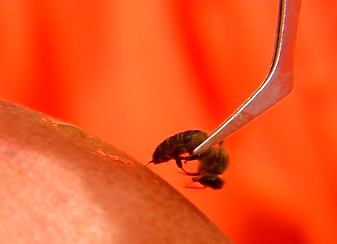 bee venom being applied during apitherapy session by holding a live bee to patient's skin using tweezers.